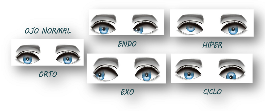 Tipos de desviaciones oculares - Visualia